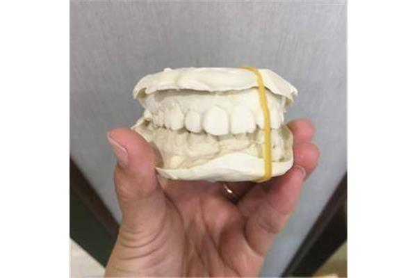 矯正牙齒要多久才可以取下托槽?