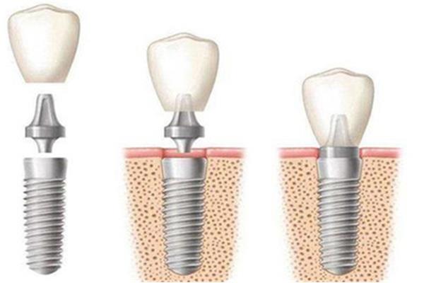 種植牙能持續多久,種植牙疼痛一般持續多久?