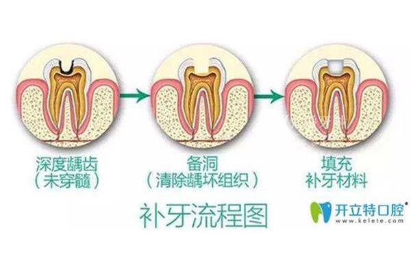 補好的牙齒壽命有多久