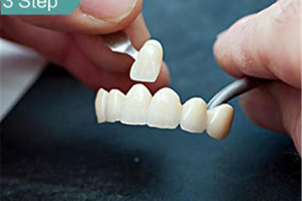 什么是臨時牙? 拔牙多久可以裝臨時牙