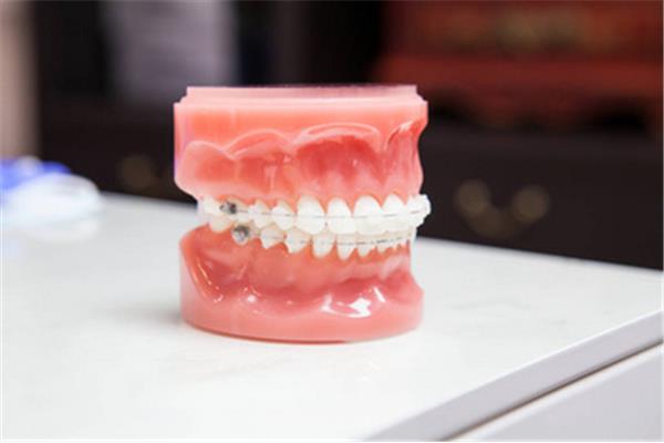 隱適美矯正牙齒方法步驟 做牙套取模型要多久