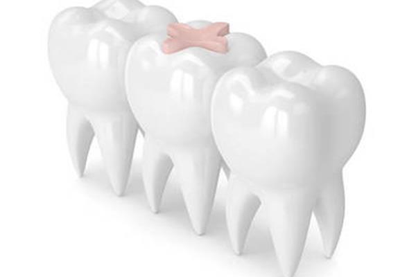 牙齒做嵌體要多久