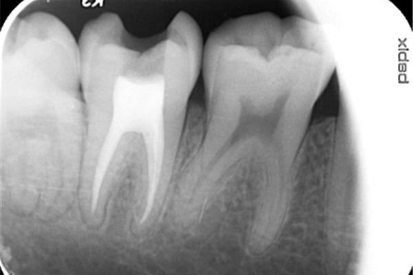 根管治療后的磨牙要做牙套嗎?建議咨詢牙醫