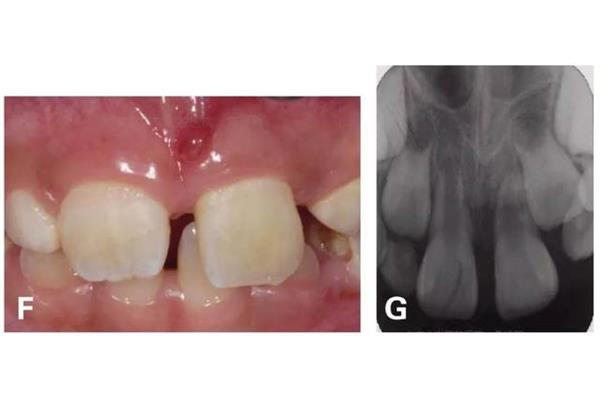 恒牙外傷觀察多久牙齒