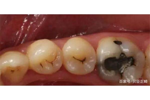 蛀牙會持續多久?蛀牙的基本知識