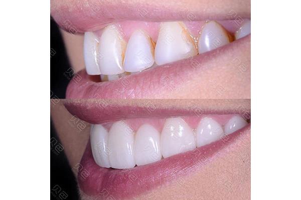 樹脂補牙多久能刷牙?需要怎么護理?