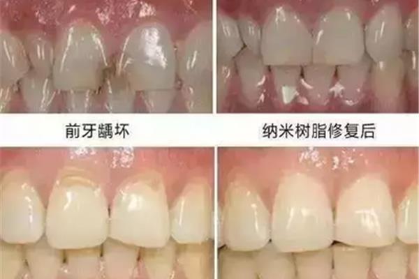 樹脂補牙有什么優勢? 樹脂補牙多久才能刷牙