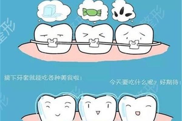 牙齒矯正后需要多久才能飲食