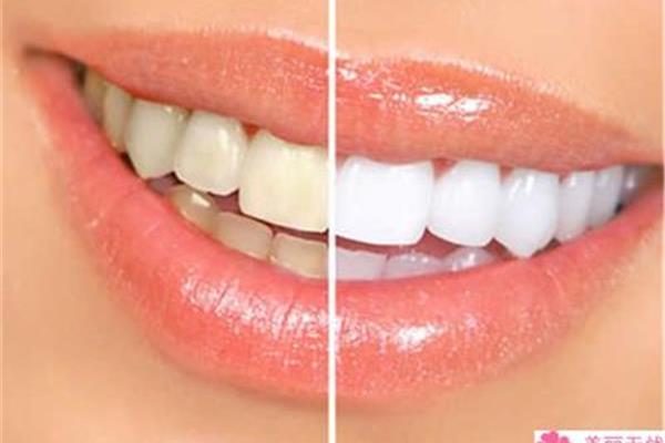 定期洗牙有助清除牙菌斑和牙結石