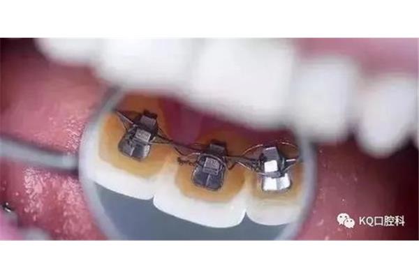 正畸牙齒帶牙套會痛多久?醫生:一個月左右復診