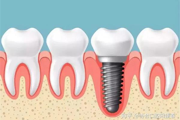種牙過程有哪幾個步驟? 安裝種植牙的過程需要多久