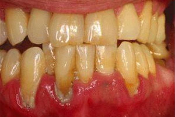 慢性根尖牙周炎如何治療? =急性牙周炎怎么治療?