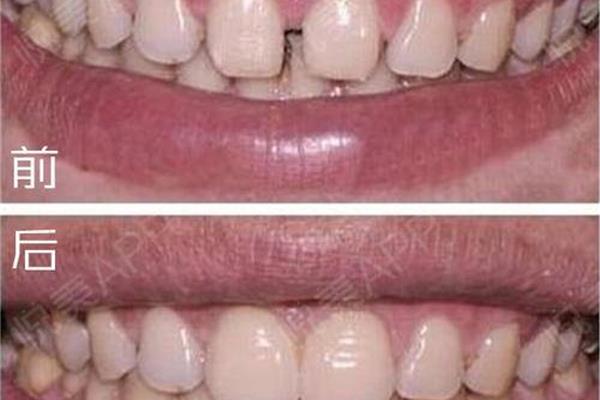 牙齒美容冠可保持多久 做美容冠得多久