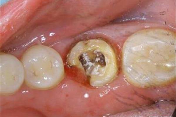 牙隱裂怎么治療? 小孩子的蛀牙多久需要治療?