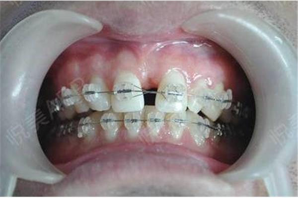 成年牙齒矯正需要多久? 牙齒矯正需要多久?