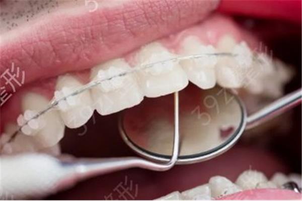 牙齒正畸手術帶牙套要多長時間?