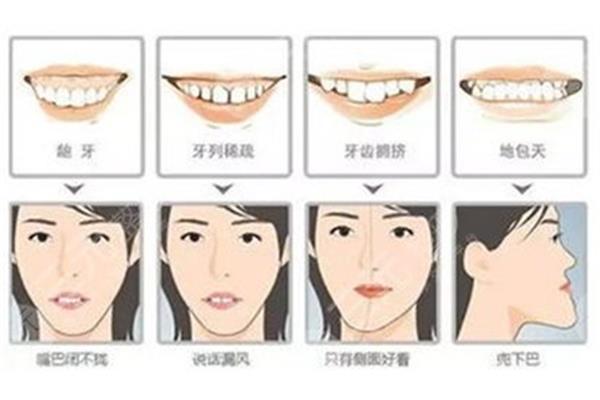 牙齒前突怎么矯正?一般需要多長時間?