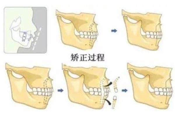 牙齒矯正要多長時間與矯正方法選擇相關