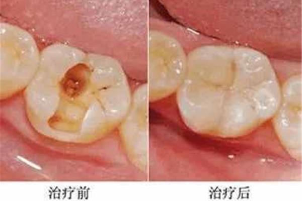 復合樹脂補牙能用多久