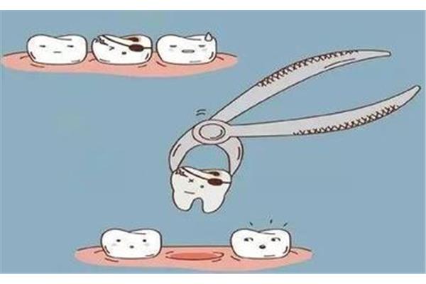 拔牙齒到底多久才能恢復 智牙拔一顆多少錢