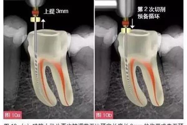 牙齒根管治療要多久? 牙齒根管治療要多久?
