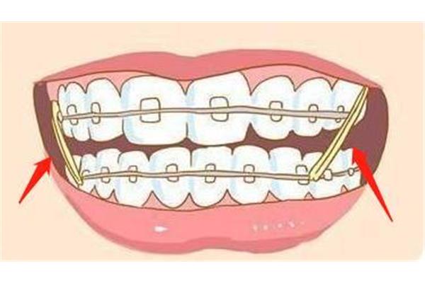 正畸牙齒有多長的橡皮筋?一般正畸牙齒有幾個月的橡皮筋