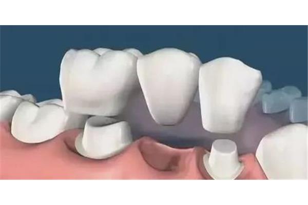 一副假牙能用多久,一副假牙能用多久?