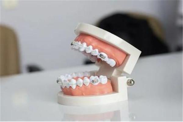 假牙套能戴多久? 牙套的作用 牙套要戴多久