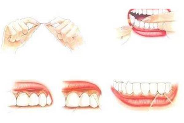 樹脂牙可以用多久?樹脂牙一般能用多久?