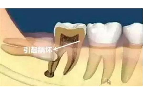 牙齒掉了多久能補牙?一般來說兩三個月最佳時機