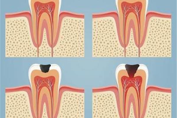 蛀牙的危害有多嚴重? 初期蛀牙一般多久變成嚴重