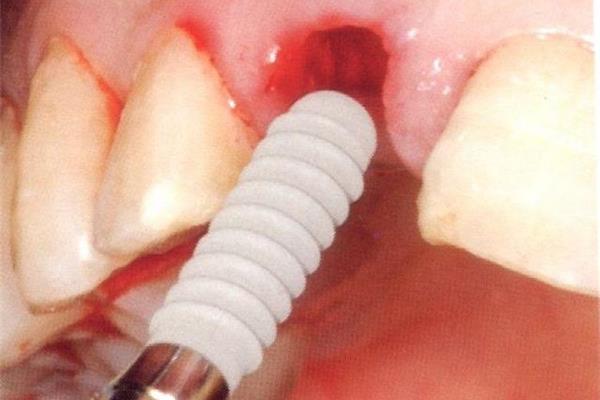 這些牙病怎么辦? 種牙多久可以裝臨時牙