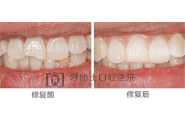 美牙冠修復牙齒的方法 牙冠能保持多久