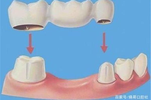 如果右上三缺失牙體完全不在建議做固定假牙
