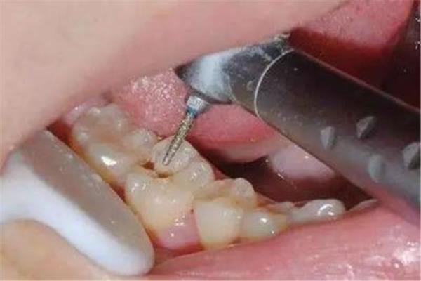 補個牙洞能保持多久
