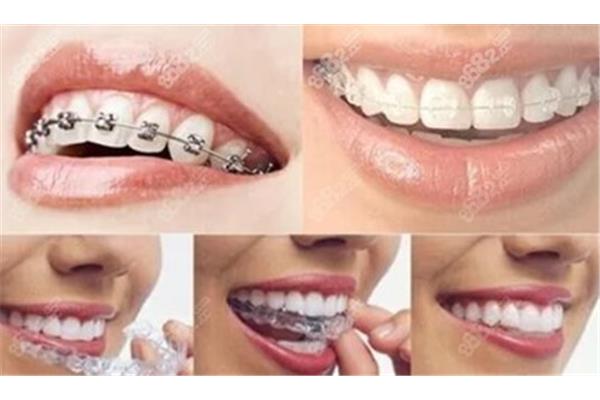 牙齒矯正和牙套矯正需要多長時間,一般戴牙套需要多長時間?