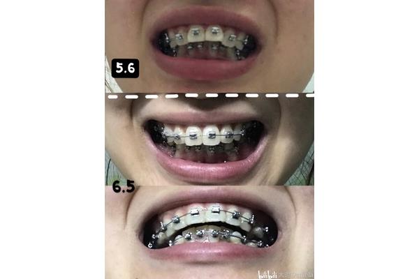 牙齒矯正多久復查一次?專家:一般一個月復診一次
