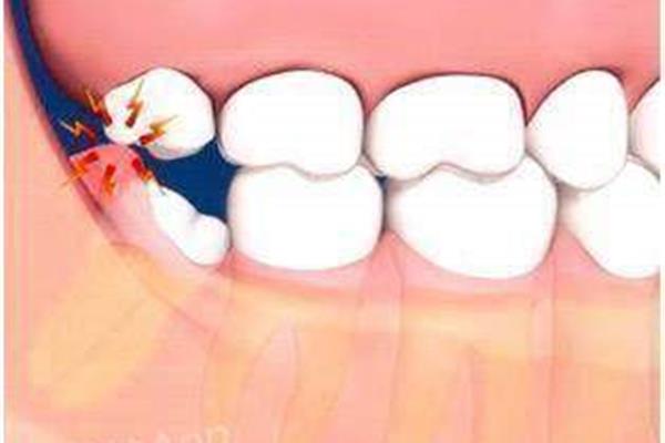 拔牙齒需要多久?一般24小時后不會疼