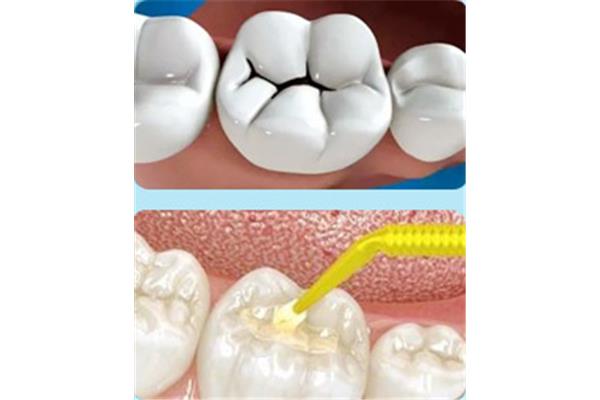 補過的牙能用多久? 樹脂補牙能用多久