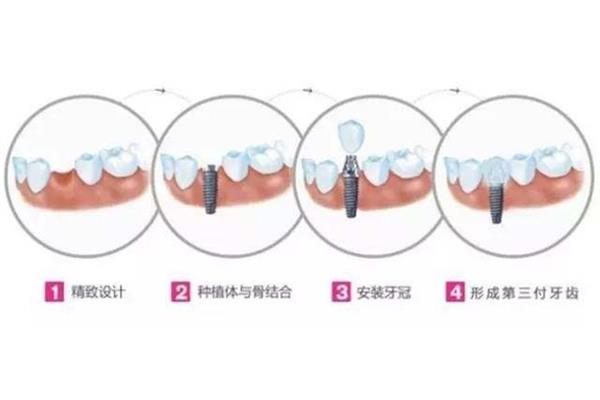 什么是種牙?人工種植牙又稱種植義齒