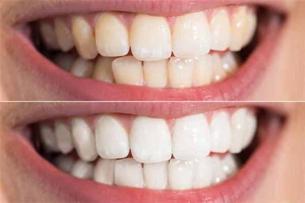 瓷貼面牙齒多久會掉?可以快速美白嗎?