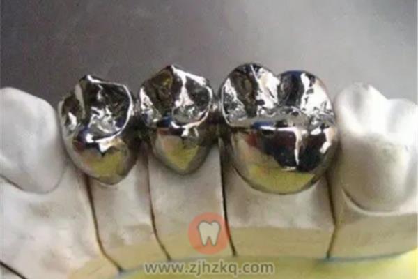 鈦合金烤瓷牙能用多久