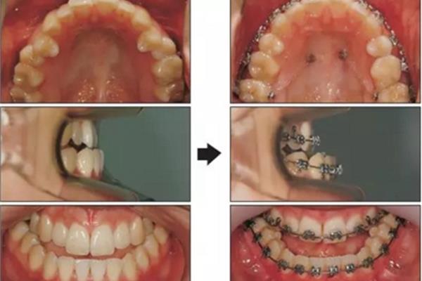 牙齒矯正需要多長時間取決于多方面因素