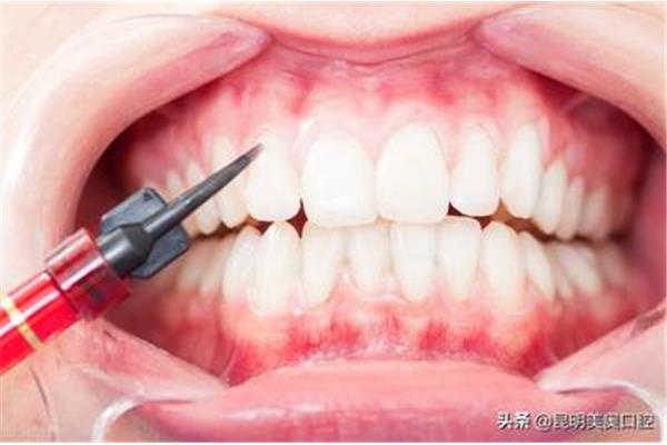 拔完牙多久能種牙? 種牙前多久拔牙