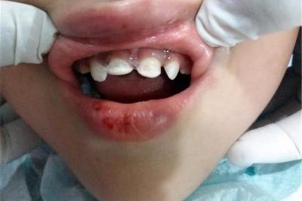 寶寶燙傷怎么辦?醫生來幫忙寶牙撞傷多久能好?