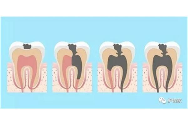 關于補牙的常識 蛀牙補好后能保持多久