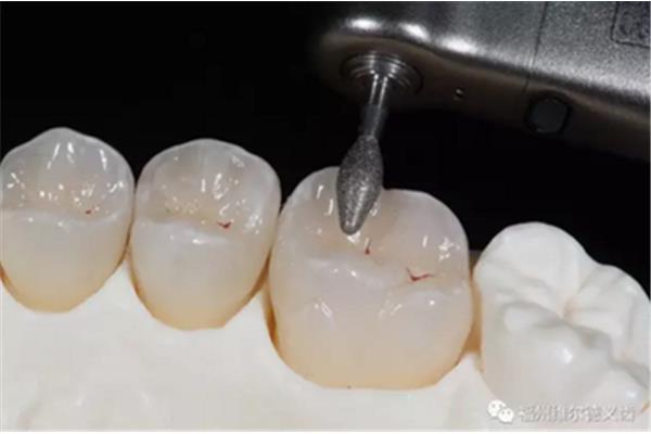 完了假牙要試戴多久,臨時假牙可以戴多久?