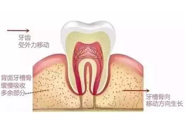 牙槽骨吸收要多久