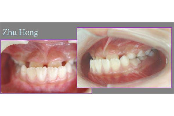 地包天二次手術后可能出現替牙期反頜
