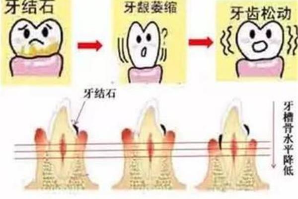 從牙根開始松動的牙怎么辦?